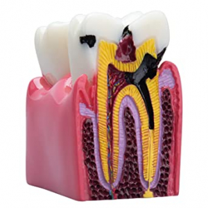 Tandmodell hål i tanden och frisk tand i gruppen HJÄLPMEDEL / Tandmodeller hos Tandshopen.se ZupperWorld AB (443452345)