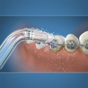 Waterpike Orthodontic Tips 2 st