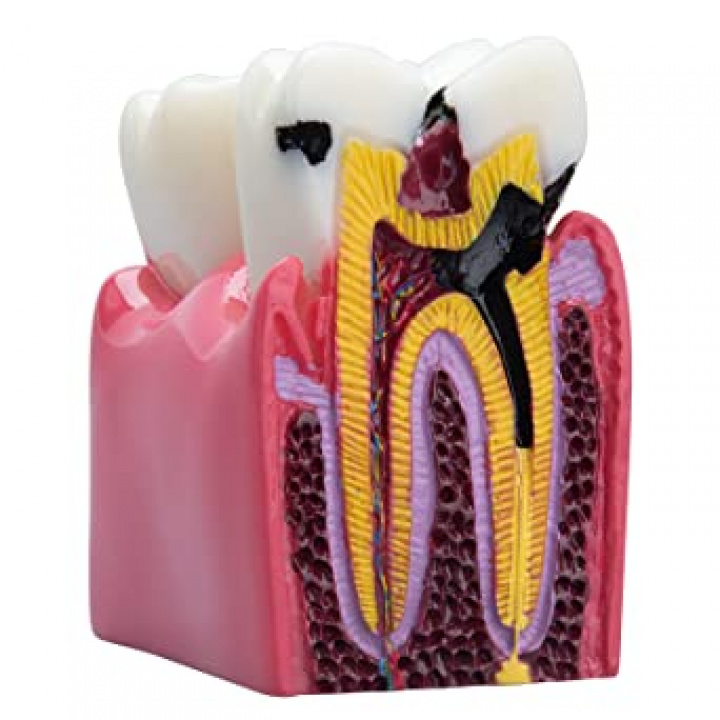 Tandmodell hål i tanden och frisk tand i gruppen MUNVÅRD / Tandmodeller hos Tandshopen.se ZupperWorld AB (443452345)