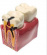 Tandmodell hål i tanden och frisk tand
